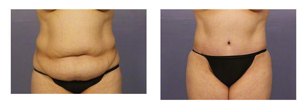 When Can You Have A Tummy Tuck After C Section - Cosmetic Surgeon