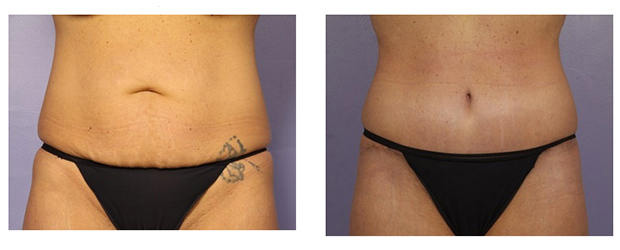 Can I Get a Tummy Tuck Without Liposuction?