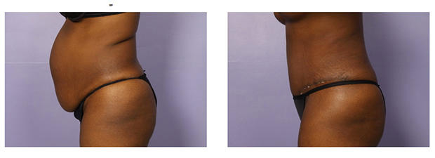 Tummy Tuck in Chelmsford - Plastic Surgery Chelmsford, MA