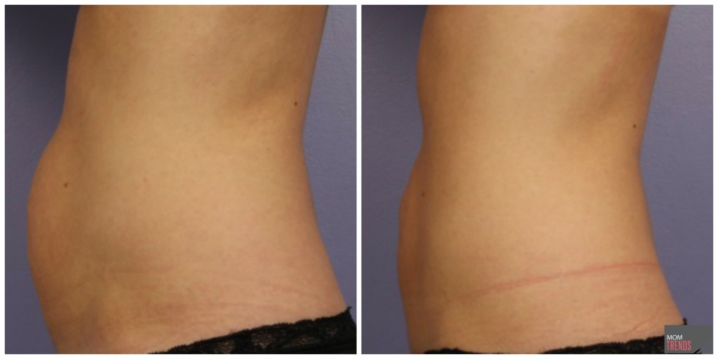 Before CoolSculpting: A Must-Read Guide