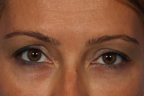 BOTOX® Cosmetic Before & After Image