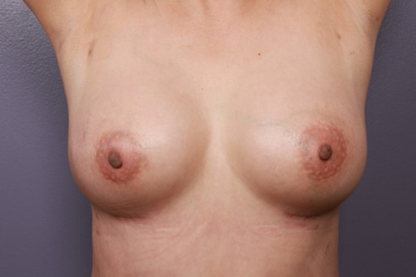 Breast Augmentation Before & After Image