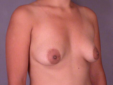 Breast Lift with Augmentation Before & After Image