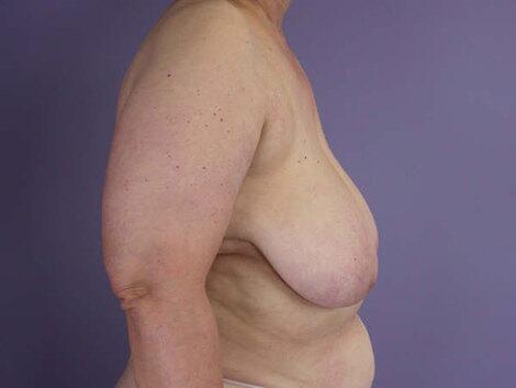 Breast Reduction (for Women) Before & After Image