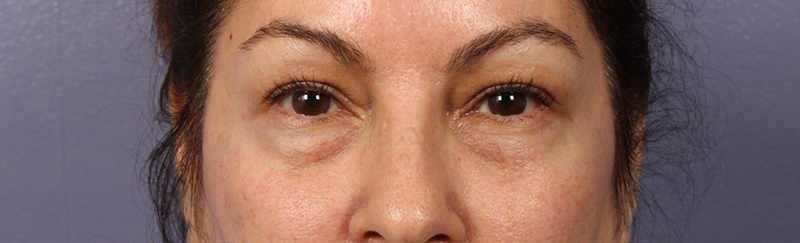 Eyelid Surgery Before & After Image