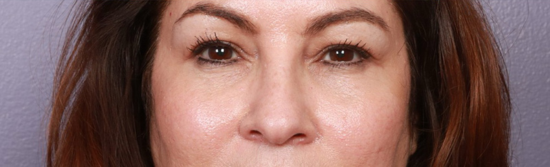 Eyelid Surgery Before & After Image