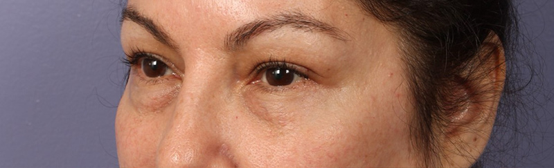 Eyelid Surgery Before & After Image