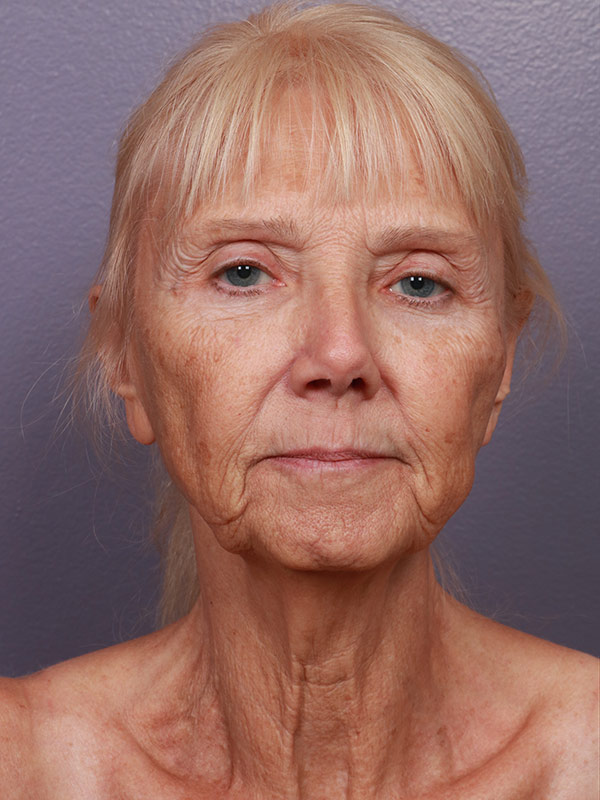 Facelift Before & After Image