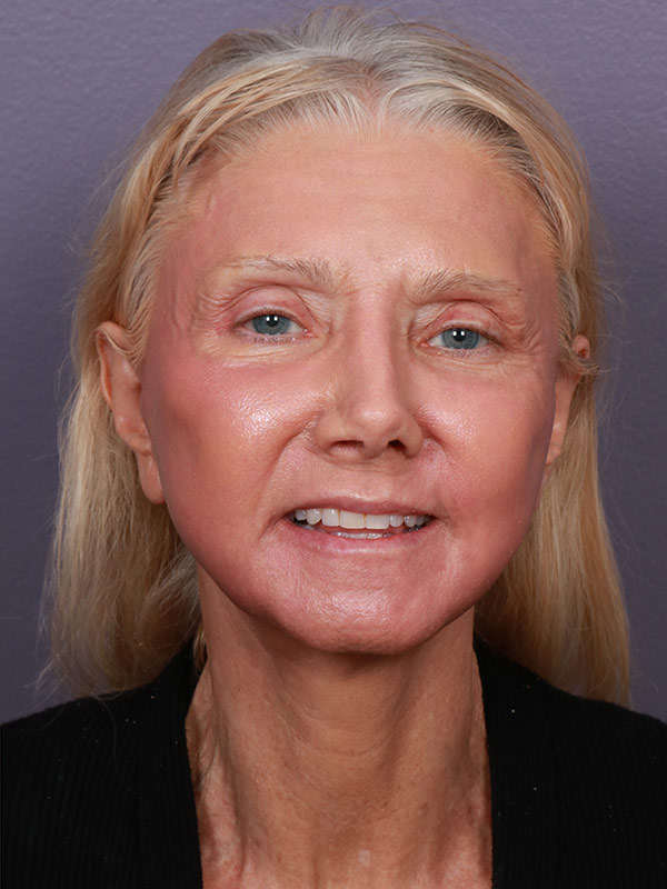 Facelift Before & After Image