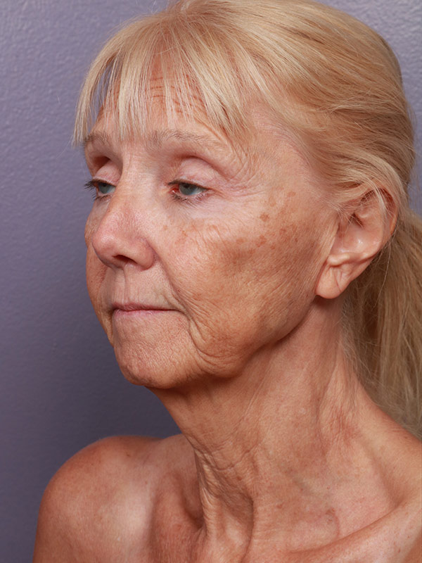 Facelift Before & After Image