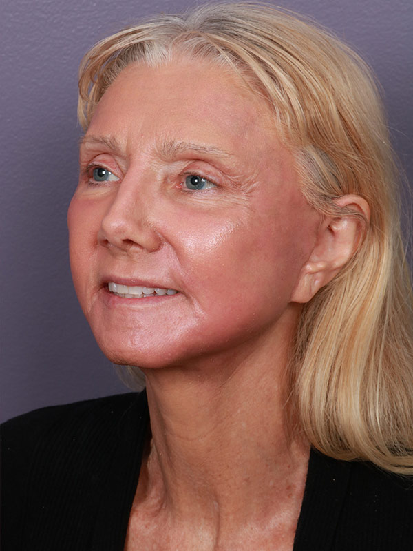 Facelift Before & After Image