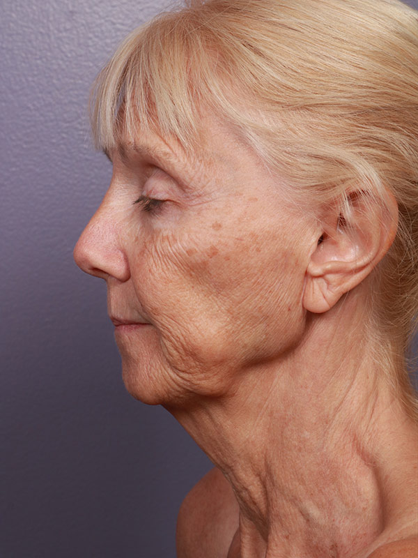 Facelift Before & After Image