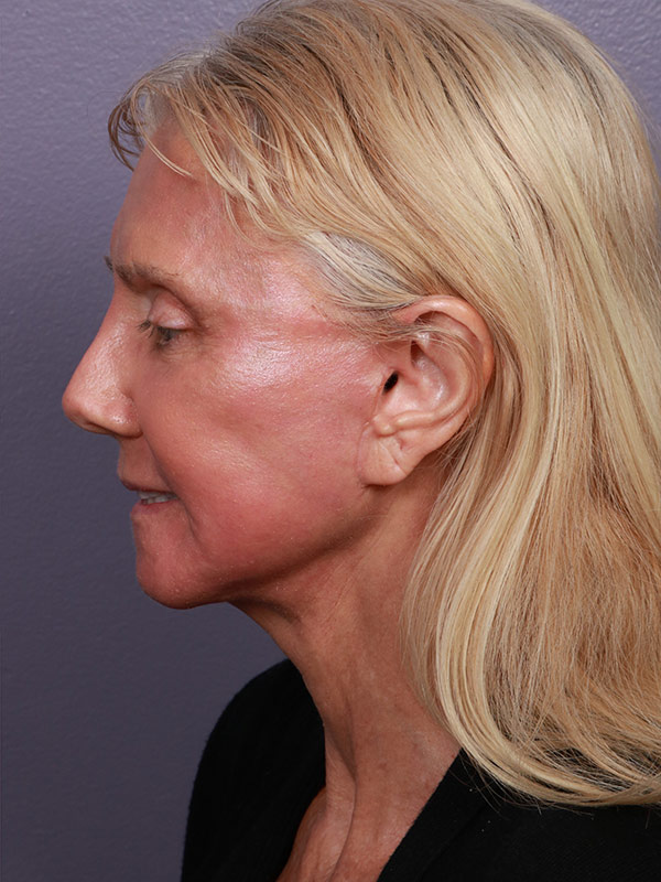 Facelift Before & After Image