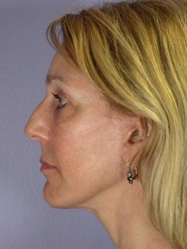 Forehead Lift (Browlift) Before & After Image
