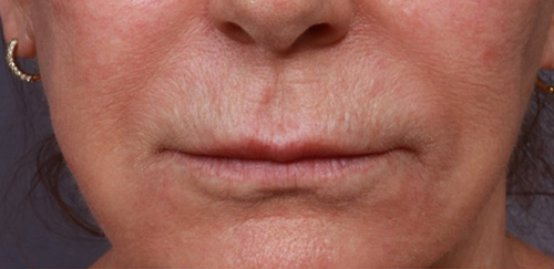 Lip Augmentation Before & After Image