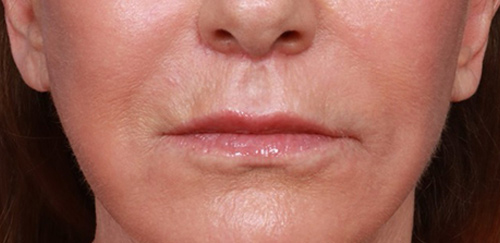 Lip Augmentation Before & After Image