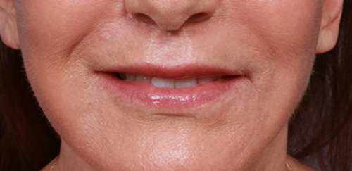 Lip Augmentation Before & After Image