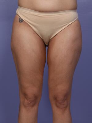 Los Angeles Liposuction Centers on X: Female patient is one year
