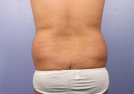 Liposuction Before & After Image