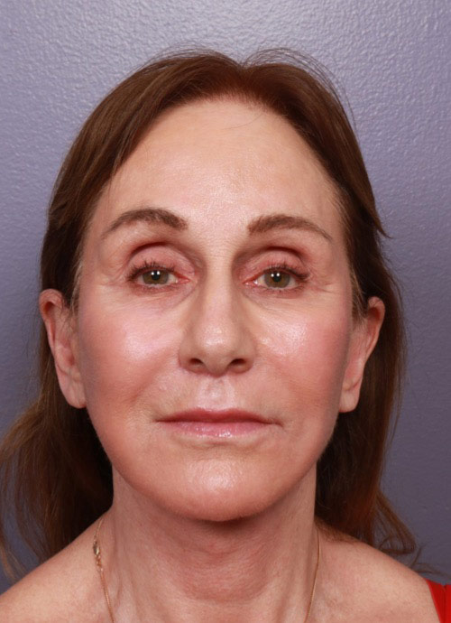 Neck Lift Before & After Image