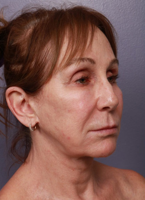 Neck Lift Before & After Image