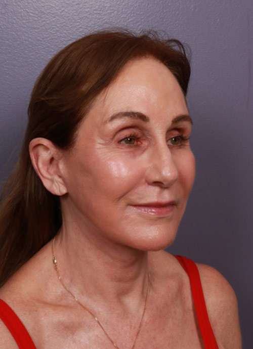 Neck Lift Before & After Image